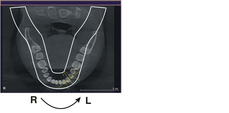 7 Viste Sirona Dental Systems GmbH Viste trasversali 7.4 Viste trasversali Le viste trasversali sono costituite da strati che sono orientati perpendicolarmente rispetto all'arco mascellare.
