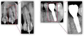 HIGH DEFINITION HD 29,6µ 1x 200x 1000x IDEALE IN ENDODONZIA E IMPLANTOLOGIA Ez Sensor Soft HD è progettato specificamente per l utilizzo in endodonzia e implantologia e garantisce l