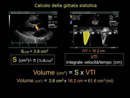 Monitoraggio L ecocardiografia permette stime affidabili dei parametri emodinamici e del loro trend di variazione nel tempo, dati correlabili ai valori derivabili dal cateterismo arterioso polmonare.