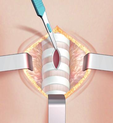 Un altra indicazione è l ustione, che richiede un intubazione prolungata.