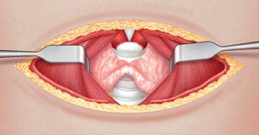 Dopo disinfezione cutanea, quattro teli sono posizionati lasciando libera la regione mediana del collo dall osso ioide superiormente all incisura sternale inferiormente.