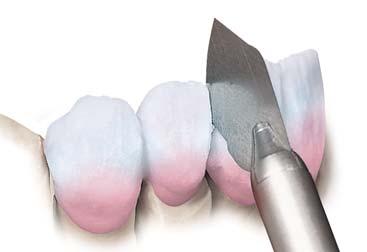 Sovramodellare leggermente per compensare la retrazione di cottura. Nei ponti, prima della prima cottura della dentina, separare i singoli elementi a livello interdentale fino alla struttura.