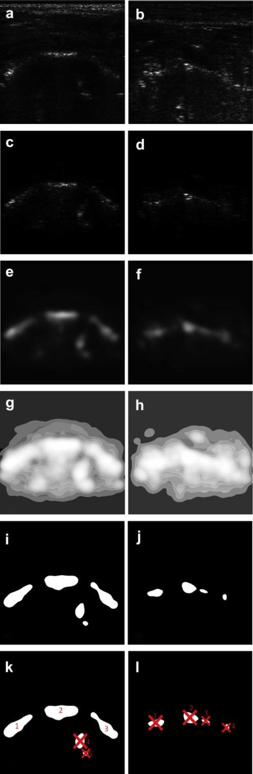 Analisi delle Immagini Identificazione Automatica delle Interfacce Ossee Target: la prima operazione effettuata dall algoritmo è l identificazione automatica delle interfacce ossee target all interno