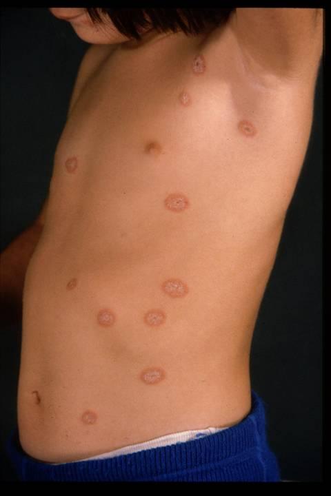 Diagnosi differenziale: tinea corporis Lesioni a coccarda con risoluzione centrale bordo