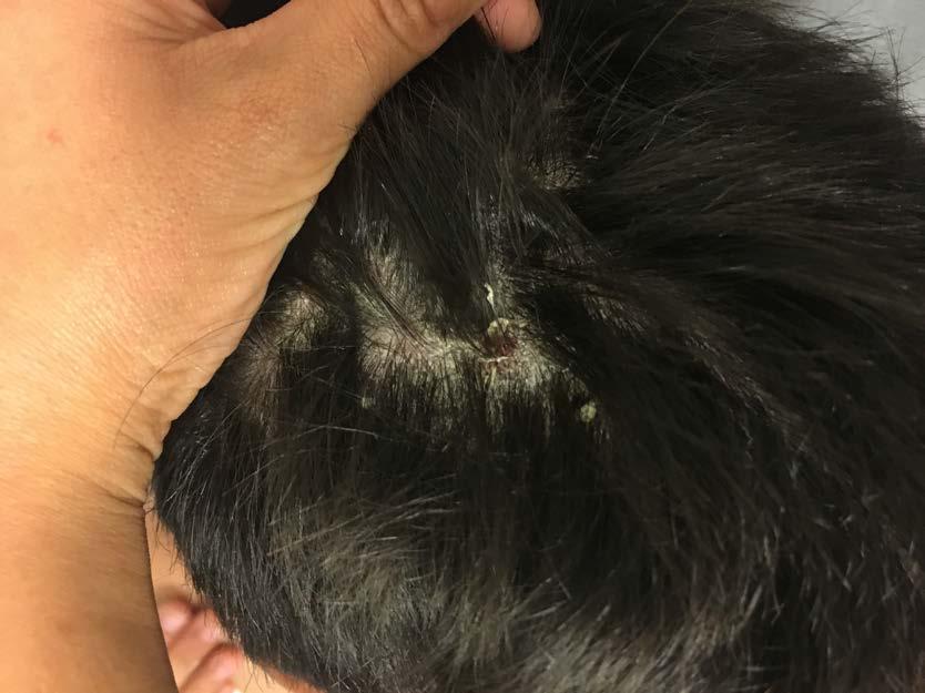 Tinea amiantacea Notevole ipercheratosi che ingloba i capelli Rischio di chiazze alopeciche e