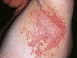 Diagnosi differenziale: dermatite da contatto allergica o irritativa Chiazze eritematose con margini mal definiti, di colore rosso vivo-rosso intenso