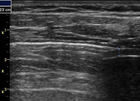 Muscle Nerve