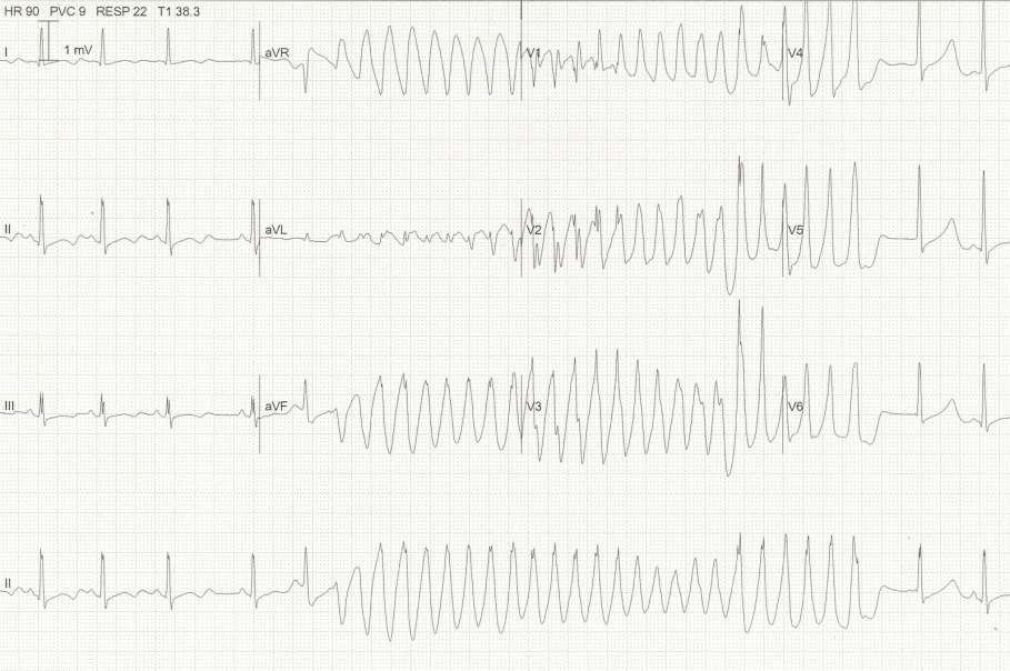 QT lungo ischemico Ipokaliemia Corso di