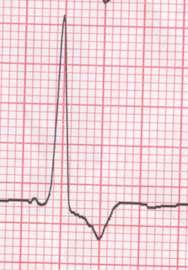 Il sovraccarico sistolico Sovraccarico Sistolico o V 5 o V 6 Tendenza: Strain del ventricolo sinistro -Tratto ST a sottoslivellarsi in basso con convessità superiore - onda T a invertirsi sulle