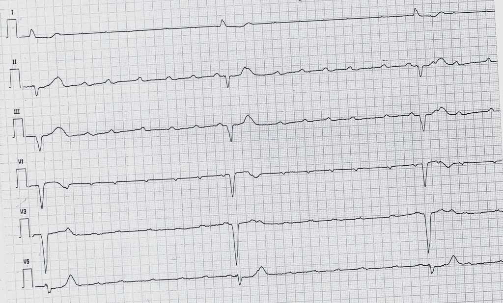 Caso Clinico 3 1 ECG analisi Complessi QRS Onde P Blocco ATRIO-VENTRICOLARE completo con ritmo