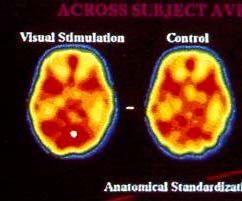 Metodologia PET: confronto tra gruppi GRUPPO A GRUPPO B #1 #2 #3 NORMALIZZAZIONE SPAZIALE ANATOMICA