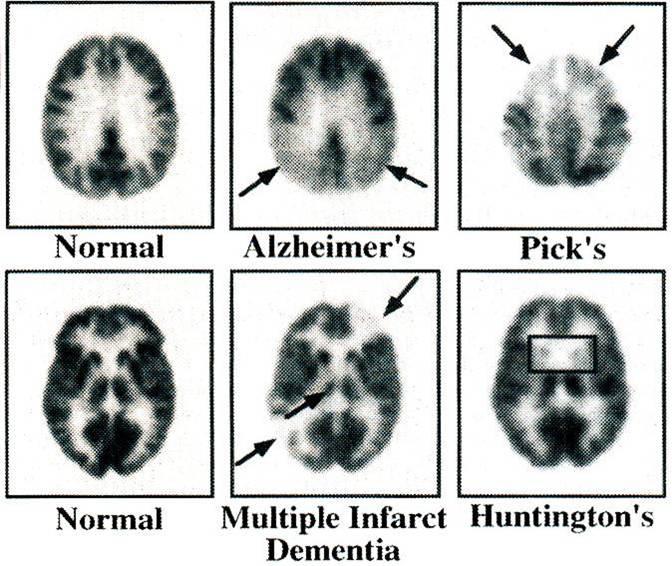 PET in the Evaluation of Dementia: