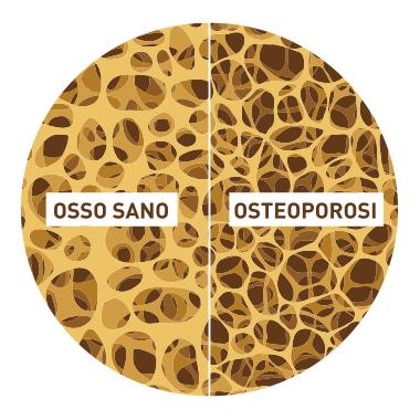OSO: trattamento Intervento nutrizionale/ terapia osteoporosi Osteopenia: intake adeguato di calcio e vit.