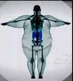 OSO: definizione La concomitante presenza di obesità, osteoporosi e sarcopenia sindrome coinvolge tutto l organismo e dalla base delle entità
