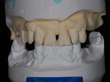 Realizzazione di un setup 1 I setup sono interventi di modifica dei modelli della situazione iniziale del paziente che servono a verificare le possibilità di ripristino della corretta dentatura prima