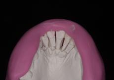 Realizzazione di un setup 6 5 5. I denti vengono quindi separati con un seghetto e quindi staccati dal modello. 6 6.