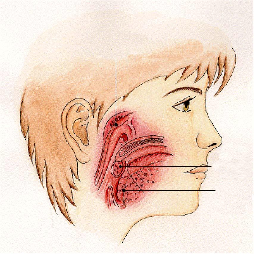 Il sistema linfatico Anello di Valdheier CSN 96 Pharyngeal tonsil Sistema difensivo specifico all ingresso del tratto respiratorio ed esofago Filtra i corpi