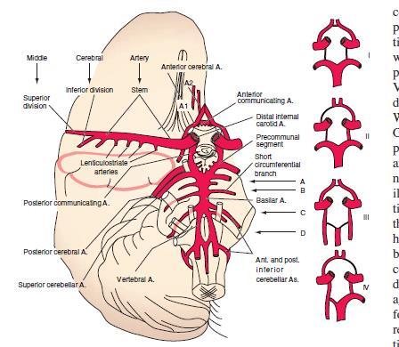 Arteria cerebrale anteriore ACA Occlusione di A1 (=pre comunicante anteriore) in genere è tollerata per flusso collaterale, se ipoplasico A1 controlaterale si hanno