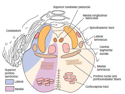 Ponte superiore: sindrome mediale e laterale Sindrome pontina superiore mediale (rami paramediani dell'arteria basilare superiore) Sul lato della lesione Atassia cerebellare: peduncolo cerebellare