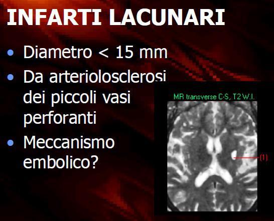 Stroke lacunari Stroke lacunari (diametro inferiore a 15 mm) sono malattia dei piccoli vasi o delle arteriole penetranti, principalmente rami della cerebrale media, della cerebrale posteriore e della