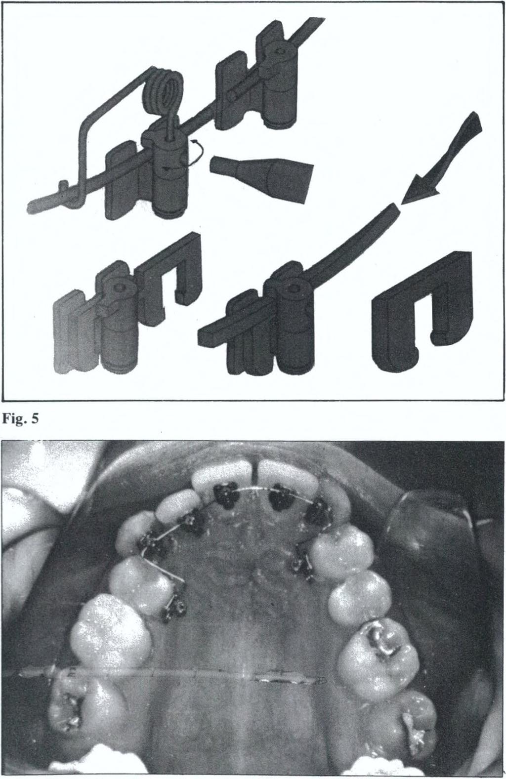 chiavistello. Nel caso di cui abbiamo parlato prima sono stati applicati questi brackets lingualmente dal primo premolare superiore di destra al primo premolare superiore di sinistra (Fig. 6).