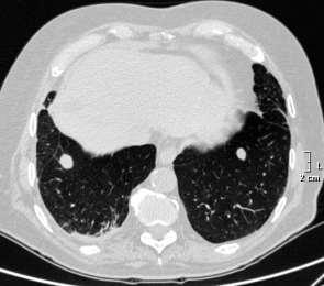 AIOM Giovani- Neoplasie Genitourinarie, Caso clinico 19/03/2018 TC torace senza mdc dopo 6 mesi di