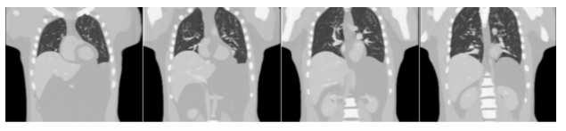 Perché l esame 4D PET/CT Gated?