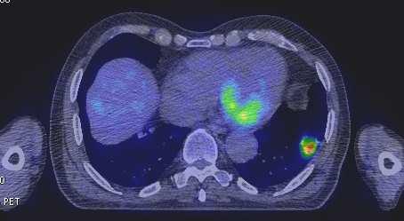 Risultati del 4D PET/CT Gated Permette la