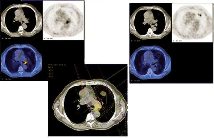 Utilità clinica del 4D PET/CT Gated Utilità per la Radioterapia Definizione del