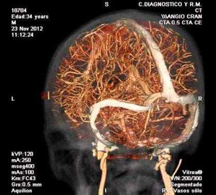 MORFOLOGIA Fratture che coinvolgono il canale carotideo implicano dissezione, pseudo aneurisma, trombosi della carotide. Richiedono Angiotac.