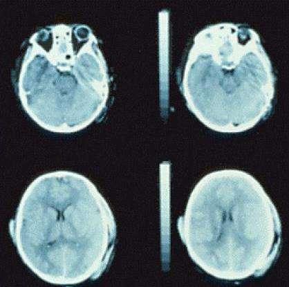 contrasto fra sostanza bianca e grigia oppure multiple emorragie puntiformi tra