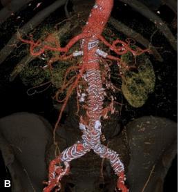 Initial experience with a new fenestrated stent graft Easily