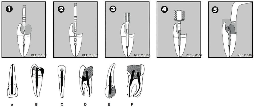 Campo di applicazione: in caso di sostanza dentale residua insufficiente (< 4 mm), il perno RS Radix-Stifte viene impiegato per supportare l'otturazione della corona.