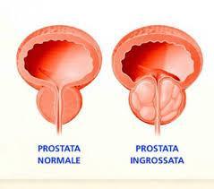 Gestione della prostatite Nella maggior parte dei casi il trattamento domiciliare è sufficiente Se la prostatite acuta batterica comporta anche