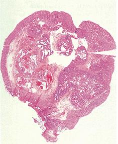 ADENOMA