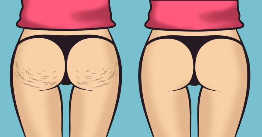 La cellulite E una manifestazione topografica della pelle associata a depressioni o introflessioni, frequenti nella zona pelvica e addominale, nei fianchi, sui glutei e nelle cosce.