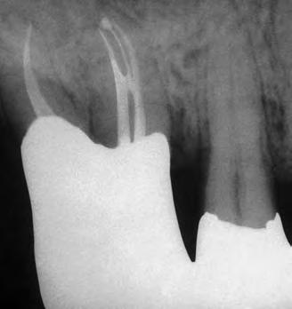 Per questa ragione, il clinico coscienzioso deve presupporre che tutti i primi molari superiori abbiano quattro canali fino a quando non si sia dimostrato il contrario.