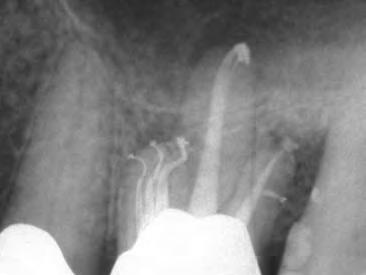 Notare l eccitante e complessa anatomia endodontica contenuta all interno della radice mesiovestibolare. Figura 4 Un primo molare superiore con 5 canali.
