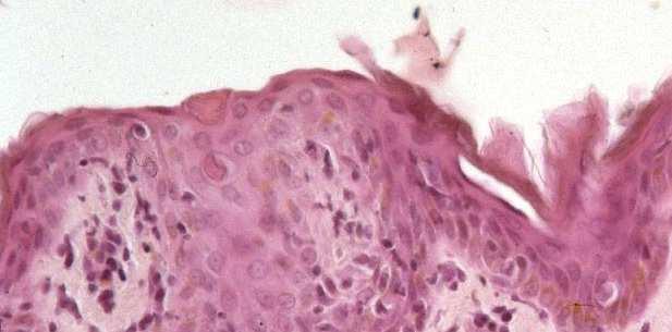 Cellule apoptotiche nella cute (lupus
