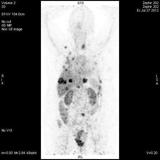 The!ZEPHIR!Trial:!Study!Design! Pax erns!of! 89 ZrKtrastuzumab!PET/CT!confronted!with!FDGKPET/CT! FDG! HER2! FDG! HER2! A B FDG! All!lesions!:high! 89 ZrKT!uptake!!! HER2! HER2!IMAGING!