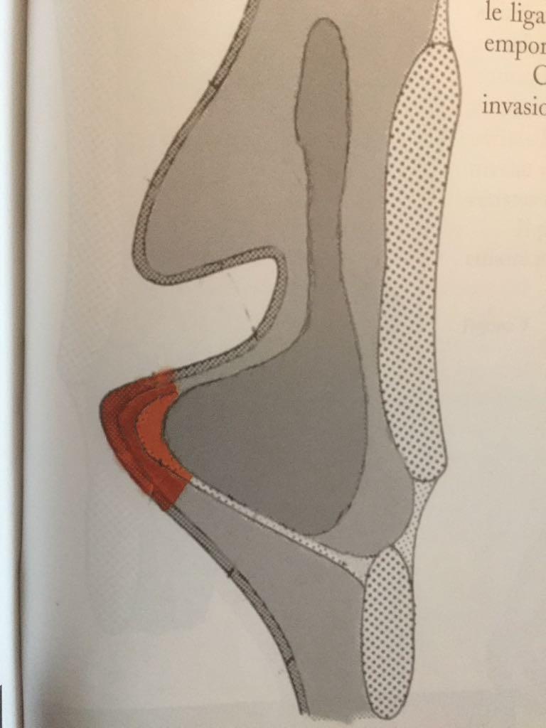 Classificazione Cordectomie Endoscopiche Laser CO2 n Type II Cordectomy