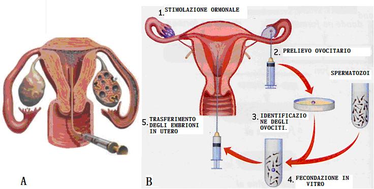 Cause di infertilità Secondo i dati dell Istituto Superiore di Sanità il 35 % dei casi è relativo a fattori femminili riconducibili a: disfunzione ormonale: amenorrea o anovulatorietà fattore uterino