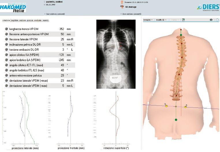 Caso clinico: scoliosi idiopatica Paziente di 11 anni affetta da scoliosi minore a doppia curva (dorsale destro-convessa, dorso-lombare sinistro-convessa)