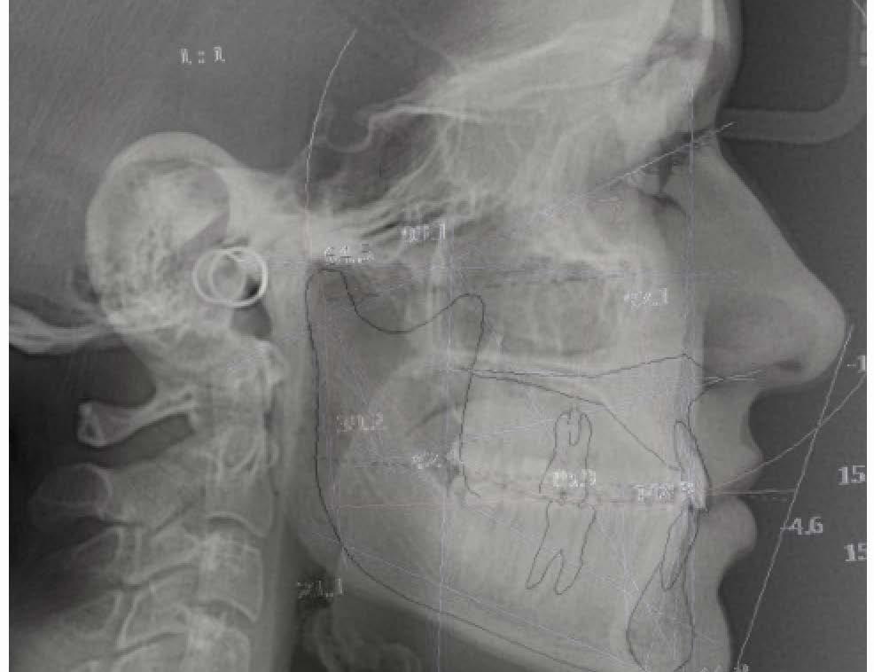 IL CORSO APPROCCIO GNATOLOGICO NELLE RIABILITAZIONI ESTETICO- FUNZIONALI COMPLESSE ECM: OBIETTIVO FORMATIVO DI SISTEMA LINEE GUIDA - PROTOCOLLI - PROCEDURE 50 ECM PRESENTAZIONE DEL CORSO 14 posti 50