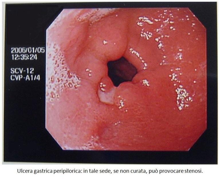 4. METAPLASIA