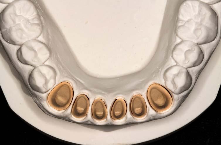 dei tessuti molli: emostasi e retrazione gengivale 2. Scansione Intraorale Computerizzata Tecniche di scansione su denti naturali e impianti Indicazioni e limiti degli scanner intraorali 3.