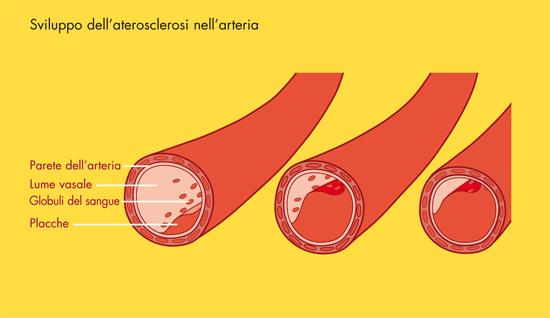 Perché troppo colesterolo nel sangue può essere pericoloso?