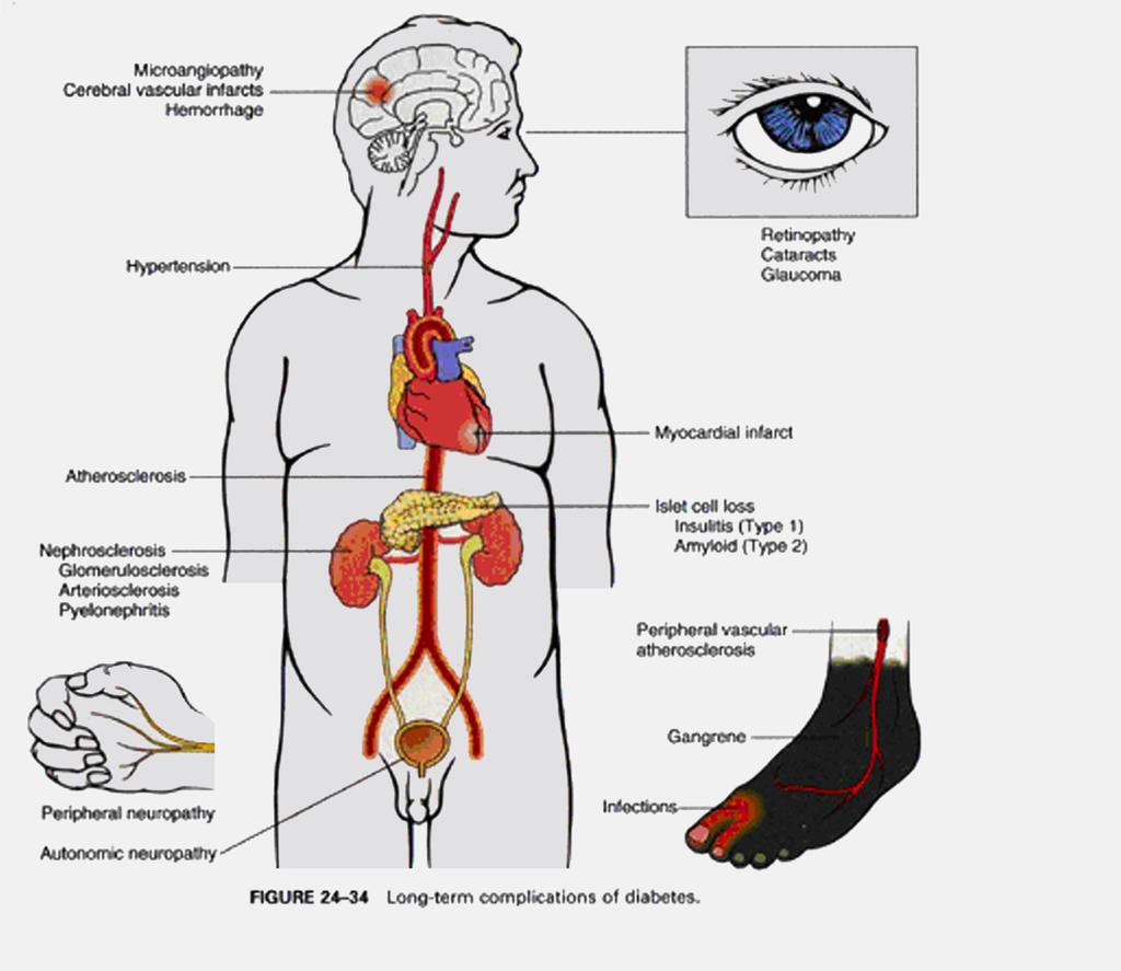 Microangiopatie Ictus cerebrale Emorragie Ipertensione Retinopatia Cataratta Glaucoma Aterosclerosi Infarto del miocardio Nefropatia