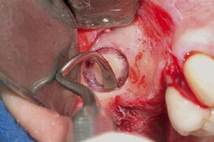 Tecnica della finestrella laterale procedura chirurgica basata su un caso clinico con approccio a due tempi Fig.