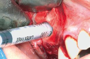 La posizione relativa di questa parete rispetto all apice del dente accanto alla regione edentula può essere stabilita con una radiografia panoramica.